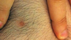Illustration for article titled Woman Grows Full Size Nipple On Foot